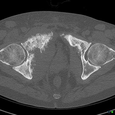 Bone metastases Radiology Reference Article