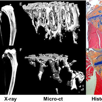 Bone metastasis - Wikipedia