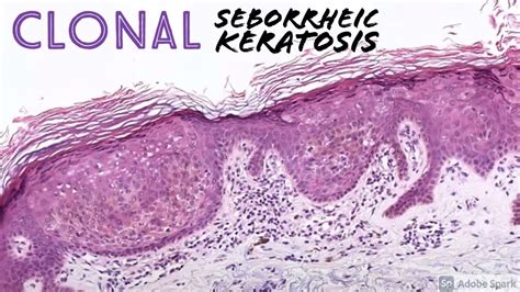 Borst-Jadassohn phenomenon - Medical Dictionary