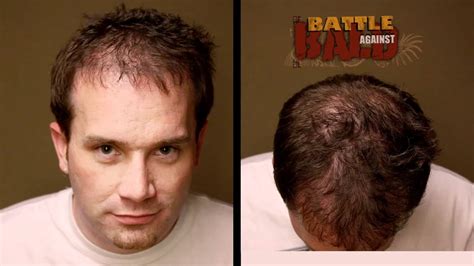 Bosley hair transplant. Things To Know About Bosley hair transplant. 