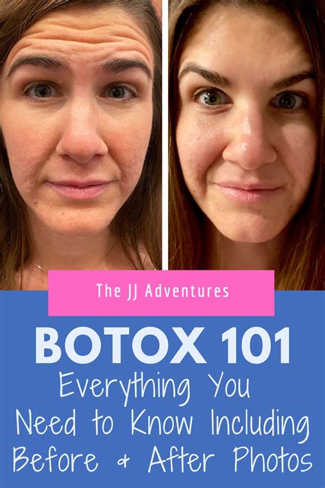 Botox 101: Everything You Need to Know