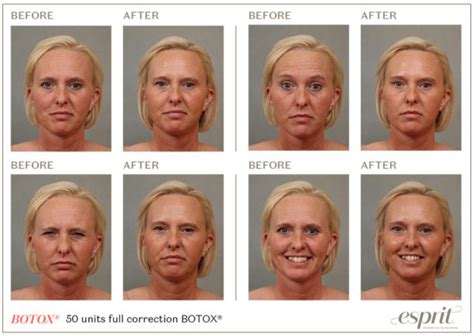 Botox Case Study by Esprit® Cosmetic Surgeons