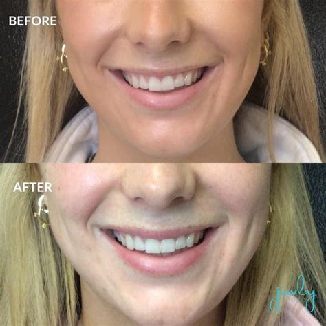 Botox Juvly Aesthetics