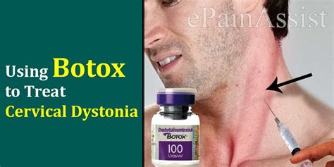 Botox for cervical dystonia Effectiveness and more