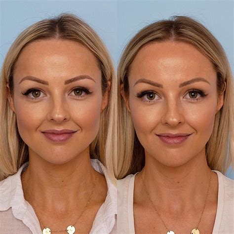 I’ve gotten masseter Botox for TMJ and it’s incredible. That area is popular for facial slimming but something else to note is that clenching and grinding bulks up that muscle leading to a square jaw, which is improved by Botox. 4.