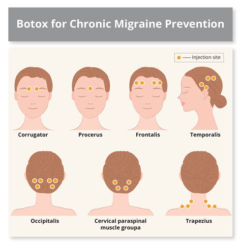 Botox for migraine Effectiveness side effects and more