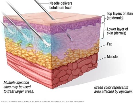 Botox injections Mayo Clinic