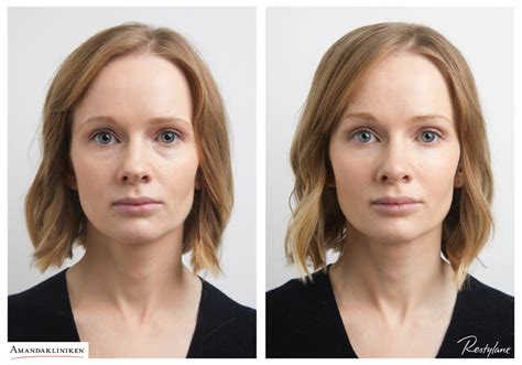 Botox och fillers samtidigt