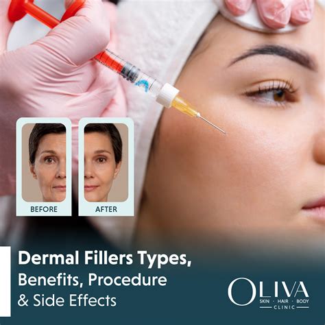 Botox upper lip side effects.  Dermal fillers are injectable gels (typically hyaluro...