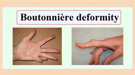 Boutonnière Deformity - Cook Children