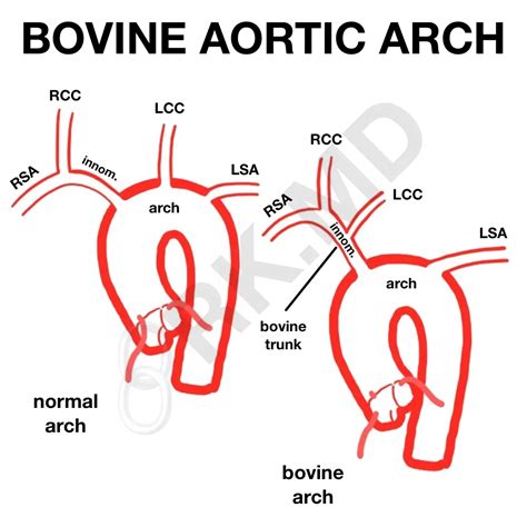 Bovine aortic arch: Prevalence in human fetuses - Goldsher - 2024 ...