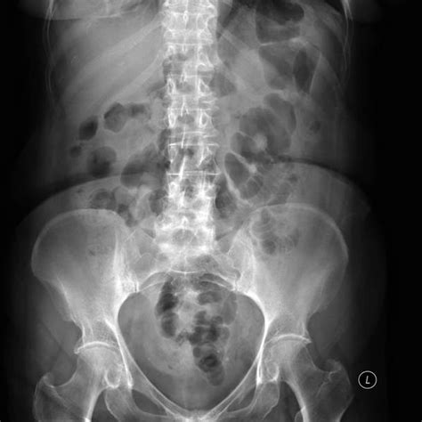 Bowel Gas RCEMLearning Netherlands