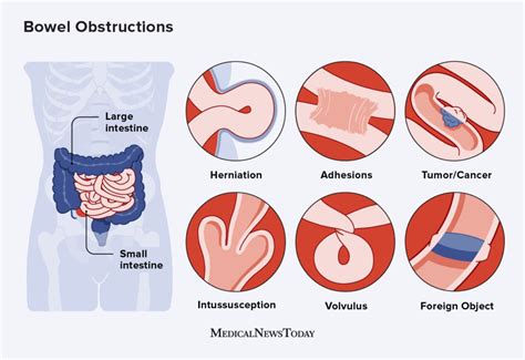 Bowel Obstruction - Causes - Management - TeachMeSurgery