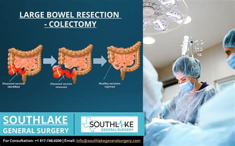 Bowel Resection (Inpatient Care) - Drugs.com