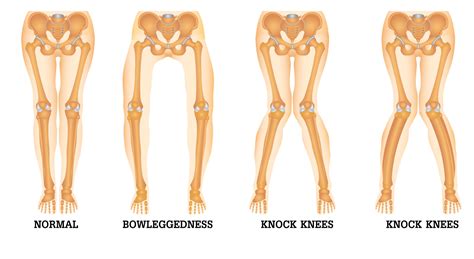 Bowlegs Definition & Meaning - Merriam-Webster