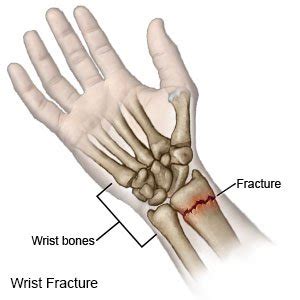 Boxer Fracture (Aftercare Instructions) - Drugs.com