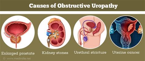 Bph With Obstruction Lower Urinary Tract Symptoms