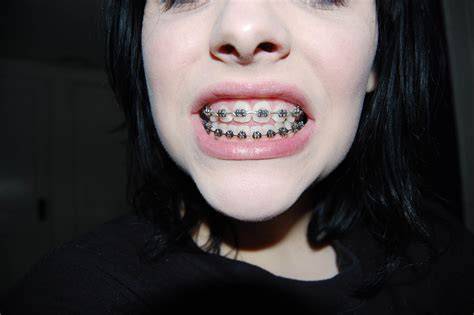 [1] Modern braces tend to be less obtrusive than the ones in classic movies where two hapless teens get stuck together. [2] However, a stray wire or bracket could poke your partner, which could kill the mood. 2 Coat your braces with orthodontic wax. Most orthodontists will give you some of this after attaching your braces.