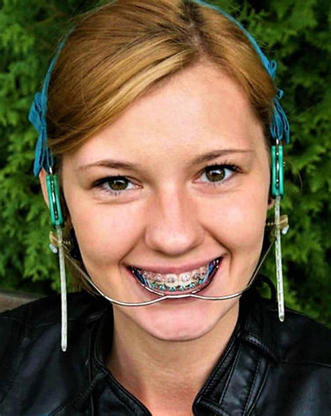 Orthodontic headgear is the general name for an appli