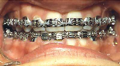 Here are ten thing that your friends and family won’t tell you about your braces. 1. They aren’t supposed to hurt. If you’re experiencing pain, especially a sharp, stabbing pain from a wire, this is an indication that something is wrong and that you need to call Dr. Gemmi and Dr. Middleberg to make an appointment to have your wire slid .... 