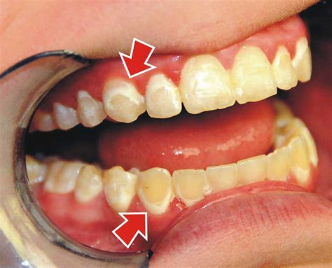 Bracket Scars and Fixing the White Spots after Braces