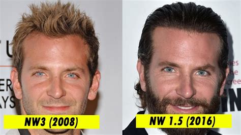 Bradley cooper hair transplant. Jun 21, 2560 BE ... ... Bradley Cooper still sporting a well-groomed beard many others want to follow suit. So, with this huge rise in beard transplants, we find ... 