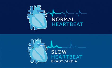 Bradycardia (Slow Heart Rate) - Living With a Pacemaker