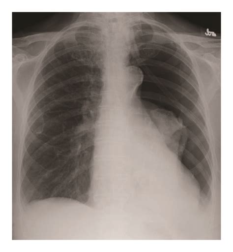 Bradycardia after Tube Thoracostomy for Spontaneous …