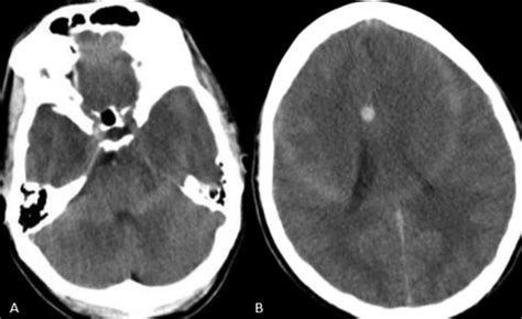 Brain CT scan. Hypodensity and loss of graywhite matter... Download
