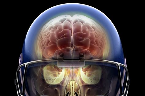 Brain Injury: CTE Found in 87% of Football Players