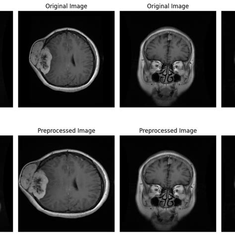 Brain Tumor MRI Image Classification Kaggle