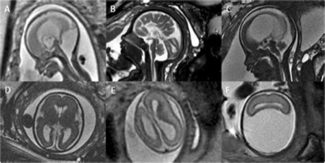 Brain death in the newborn Journal of Perinatology - Nature