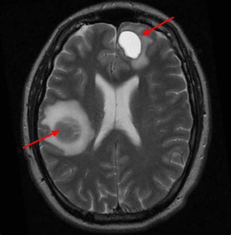 Brain metastases, melanoma — Clinical MRI