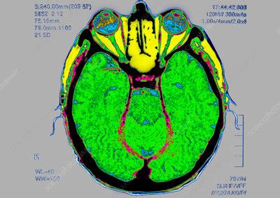 Brain scan Stock Image C012/9753 Science Photo Library
