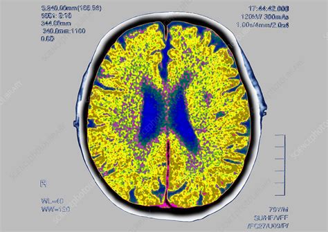 Brain scan Stock Image C012/9759 Science Photo Library