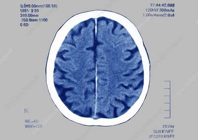 Brain scan Stock Image C012/9760 Science Photo Library