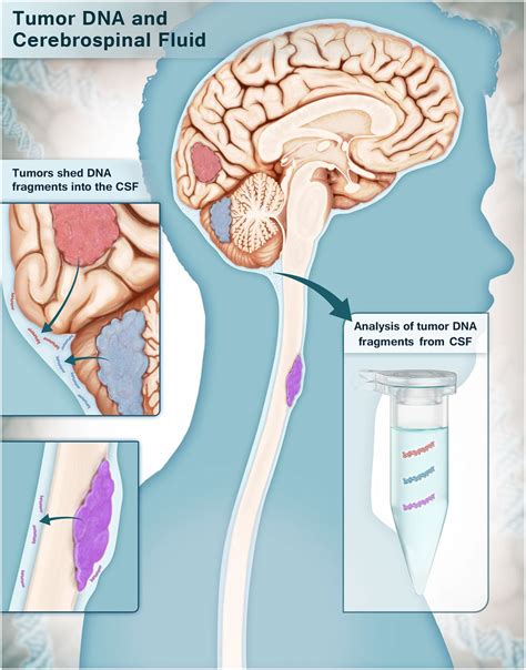 Brain tumor mutations detected in cerebral spinal fluid