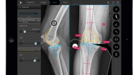 Brainlab Increases Automation in Orthopedic Digital Templating Brainlab