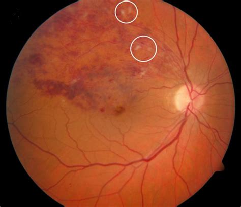 Branch Retinal Artery Occlusion - EyeWiki