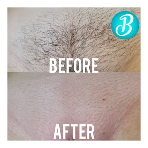 Brazilian wax before and after. In order to prepare for your wax, it's recommended that your hair is at least 1/4 inch long (about the size of a sprinkle). "It’s a good idea to stop shaving at least ten … 