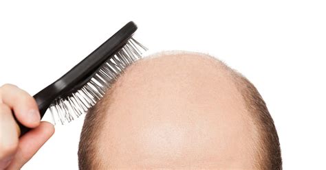 Breakthrough Male Baldness Cure Could Be On Sale Within Five …