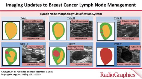 Breast Cancer and Lymph Nodes For the Girls Windchimes