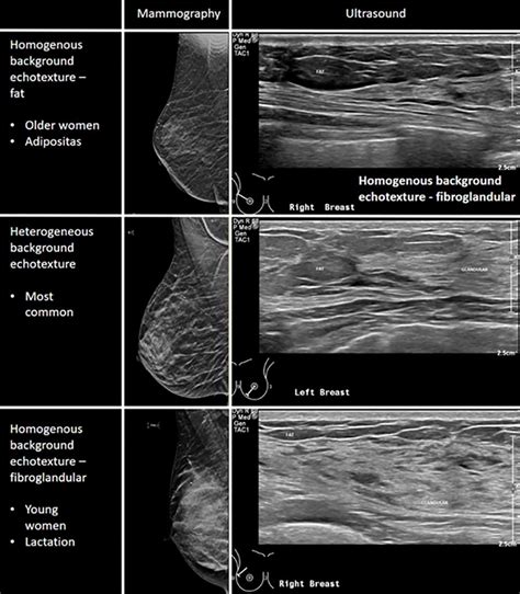 Breast Ultrasound Article - StatPearls