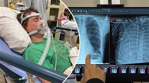 Breast implants play a crucial role in innovative procedure to save life of man with severe lung damage
