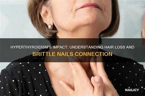 Brittle nails hyperthyroidism.  Find out how thyroid Peeling, splitting, o...