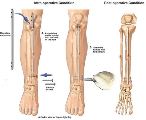 Broken tibia and fibula titanium rod recovery time.  Medical imaging f...