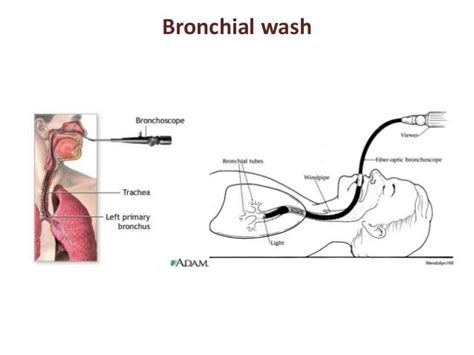 Bronchial Washings, Brushings and Aspirates