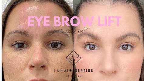 Brow Lift - Happy Life Ahead