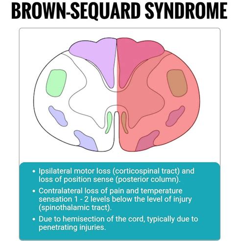 Brown Sequard Syndrome - PubMed