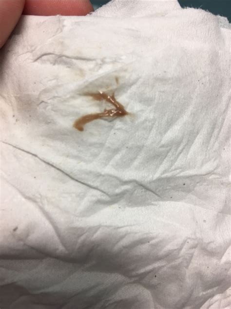 Brown discharge iud. The most common causes of brown vaginal discharge include: 1. End of a period. It is common for period blood to become darker and to reduce in quantity in the last days of menstruation. This may start to slow down and progress to a brown discharge. It is considered to be normal and disappears within 2 to 3 days. 